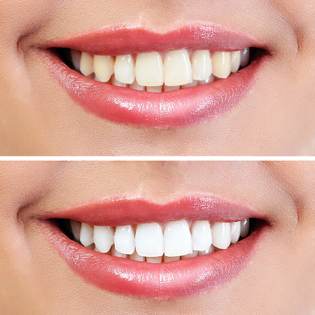 Benefits of Teeth Whitening | Robert Pearce, DDS | Point Richmond, CA